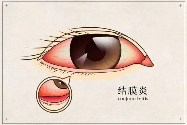 皮膚癢、拉肚子、腸胃不適、感冒，春夏換季病，艾灸來搞定！